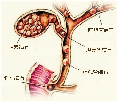 胆结石偏方