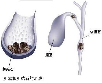 慢性胆囊炎