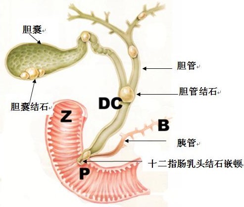 胆结石