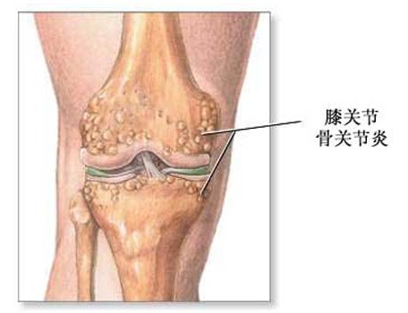 骨质增生偏方