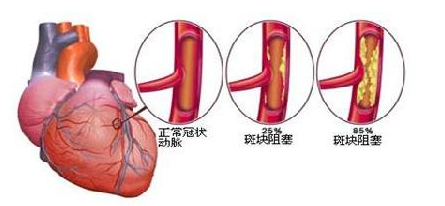 冠心病偏方