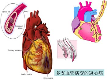 冠心病偏方