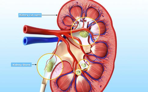 肾结石偏方